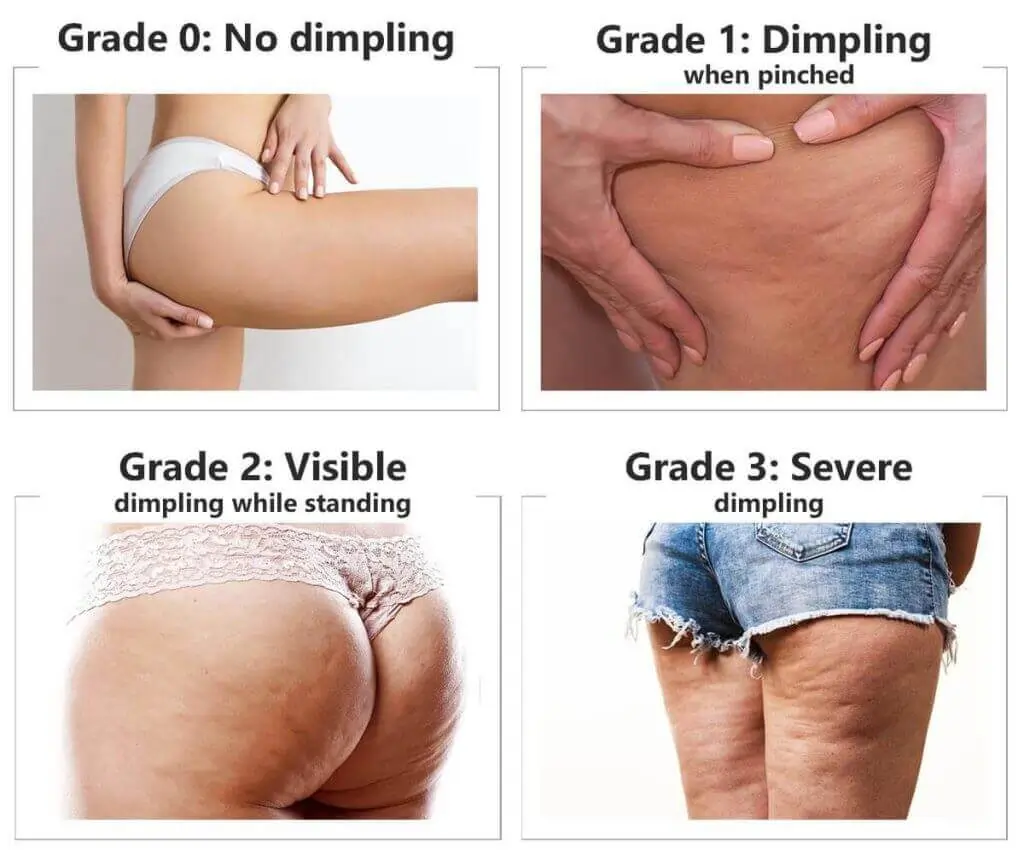 Representation of the stages of cellulite development Frimley