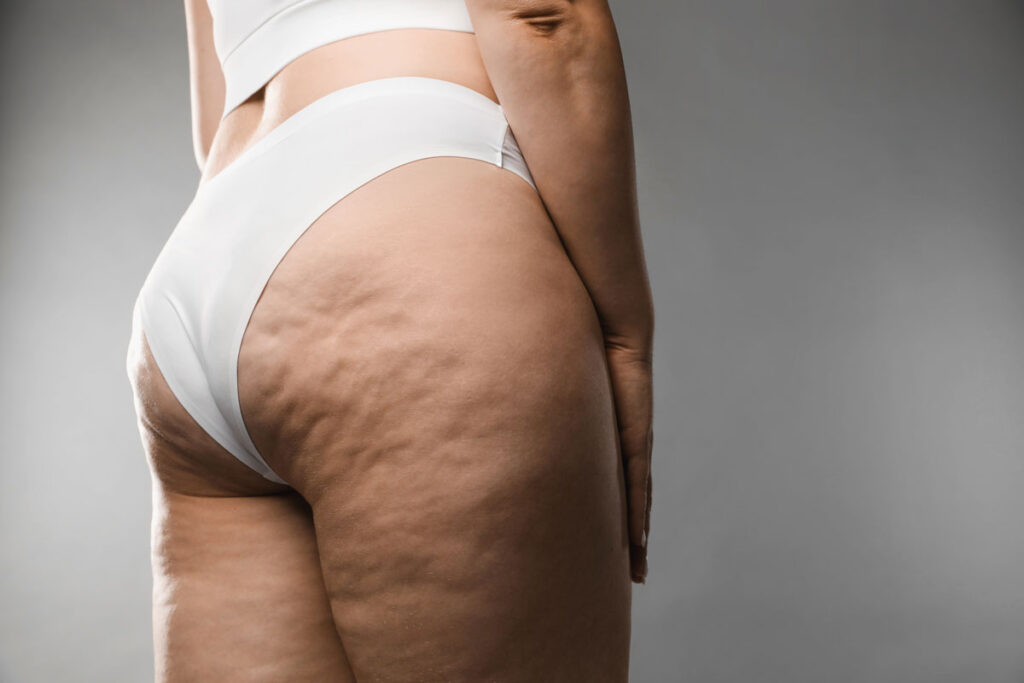 Find out how body composition contributes to the formation of cellulite in this detailed analysis